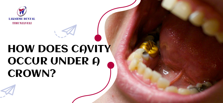 How does cavity occur under a crown