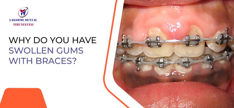 Why Do You Have Swollen Gums With Braces Dental Clinic In 