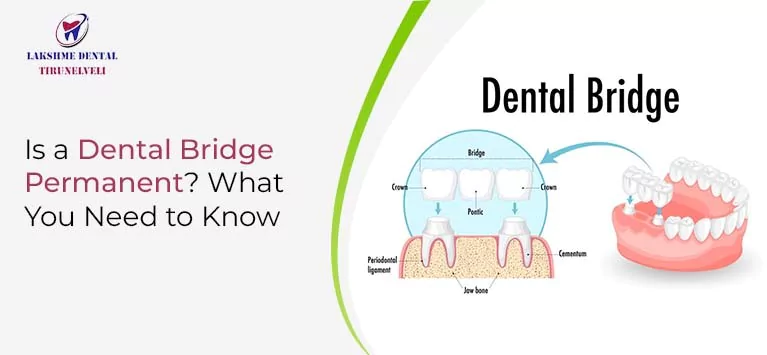 Is a Dental Bridge Permanent? What You Need to Know
