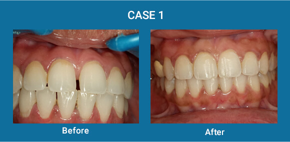 before-after