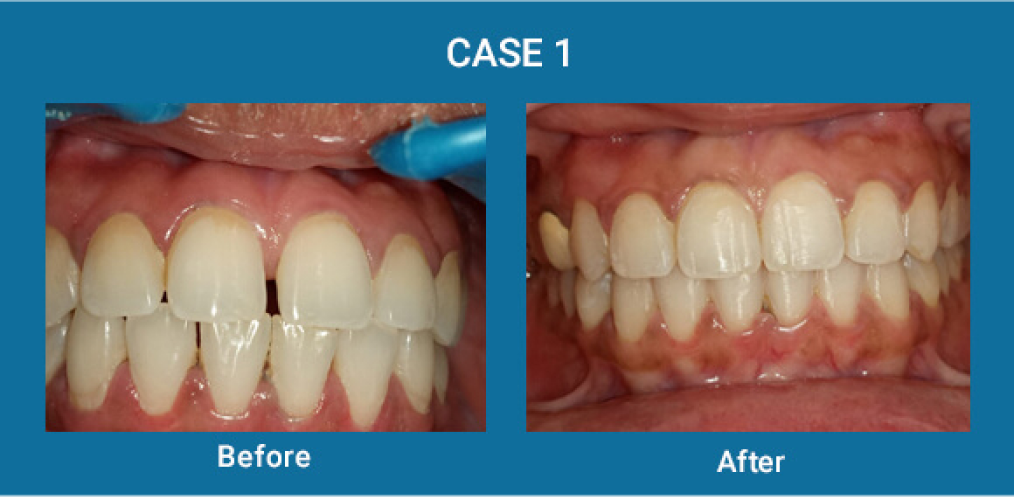 before-after