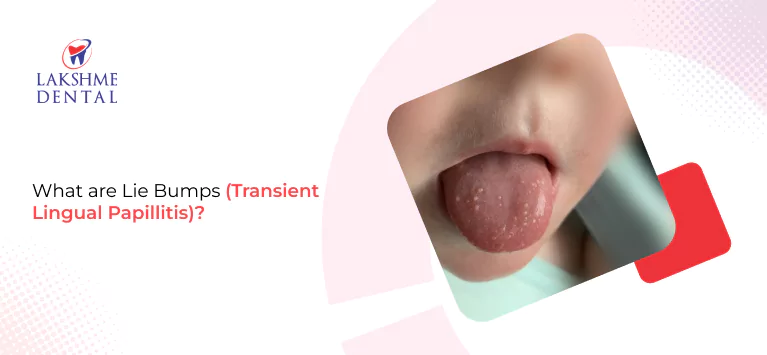 What are Lie Bumps (Transient Lingual Papillitis)?